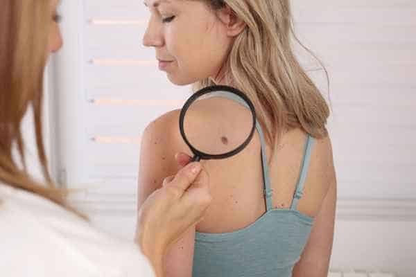 What Are Traditional Skin Lesion Removal Methods Holmes Chapel?