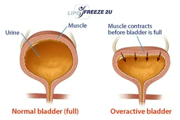 diagram of overactive bladder treatment Holmes Chapel