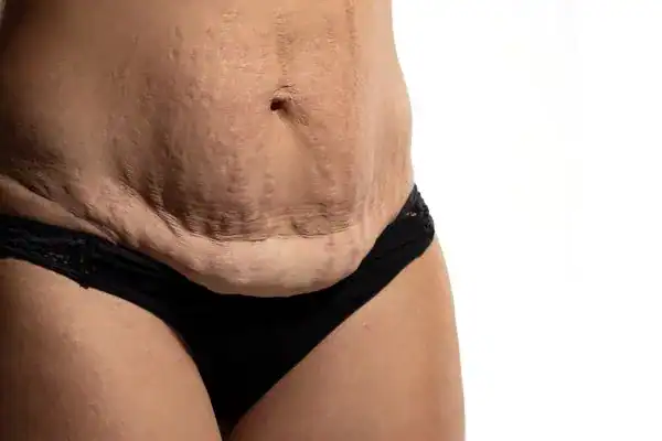 loose skin after weight loss injections Holmes Chapel