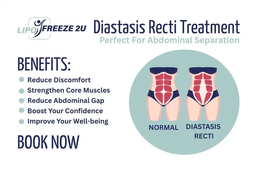 How Long Will It Take to See Improvements in Diastasis Recti Holmes Chapel