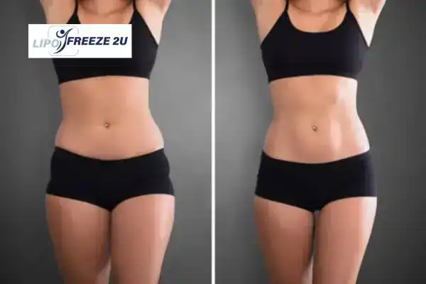 How Can LIPO FREEZE 2U Support Your Post-Pregnancy Body Recovery Holmes Chapel?