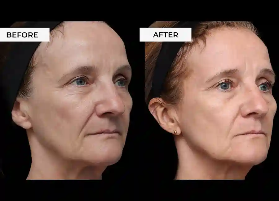 How Many RF Microneedling Sessions Will You Need to See a Difference Holmes Chapel?
