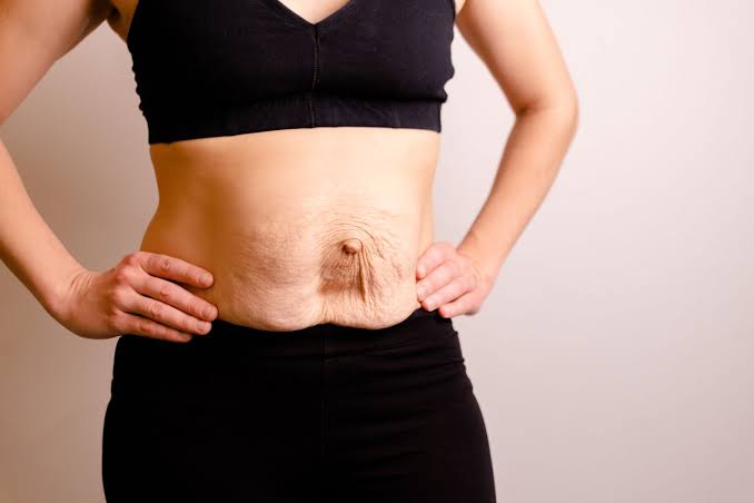 Is Surgery Really the Only Way to Repair Diastasis Recti Holmes Chapel?