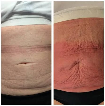 How Does RF Microneedling Improve Crepey, Thin and Uneven Skin Texture Holmes Chapel?