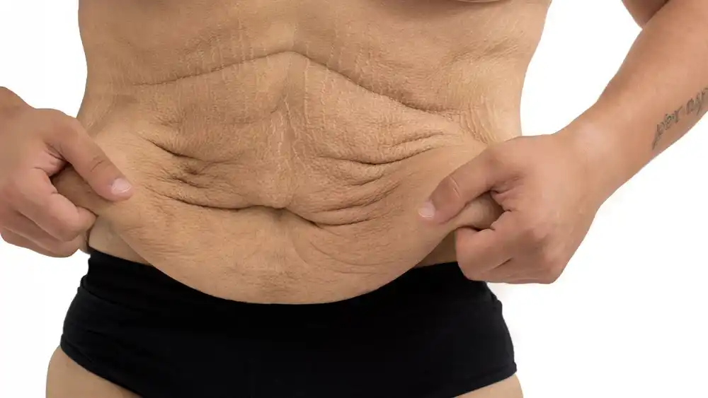 RF Microneedling for Loose Skin: How Can It Help Tighten and Reshape the Skin Holmes Chapel?